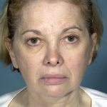 Facelift Before & After Patient #1674