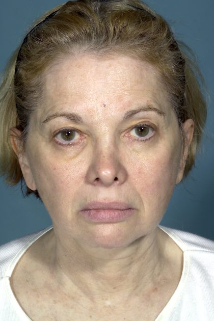 Facelift Before & After Patient #1674