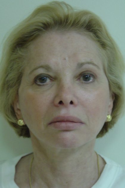 Facelift Before & After Patient #1674