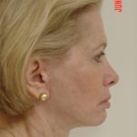 Facelift Before & After Patient #1674