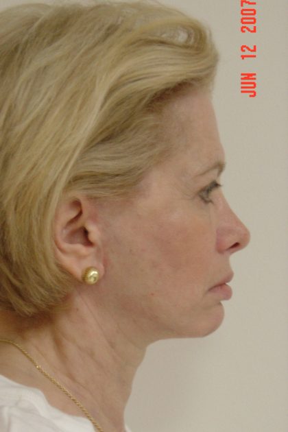 Facelift Before & After Patient #1674