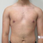 Male Breast Reduction Before & After Patient #1747