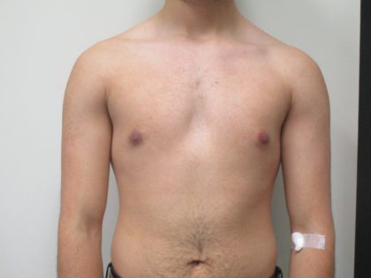 Male Breast Reduction Before & After Patient #1747