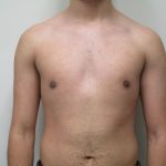 Male Breast Reduction Before & After Patient #1747