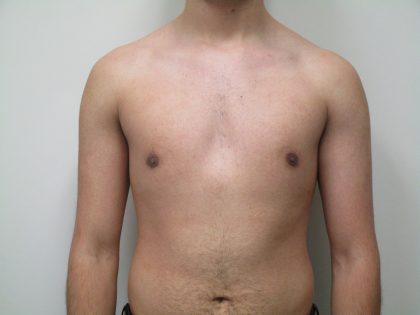 Male Breast Reduction Before & After Patient #1747