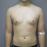 Male Breast Reduction Before & After Patient #1746