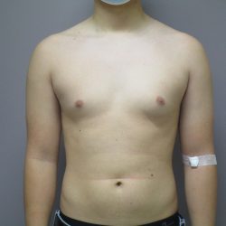 Male Breast Reduction Before & After Patient #1746