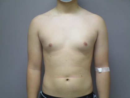 Male Breast Reduction Before & After Patient #1746