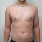 Male Breast Reduction Before & After Patient #1746