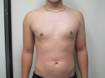 Male Breast Reduction Before & After Patient #1746