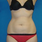 Liposuction Before & After Patient #1761