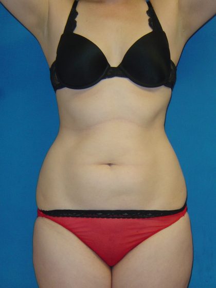 Liposuction Before & After Patient #1761