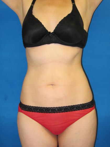 Liposuction Before & After Patient #1761