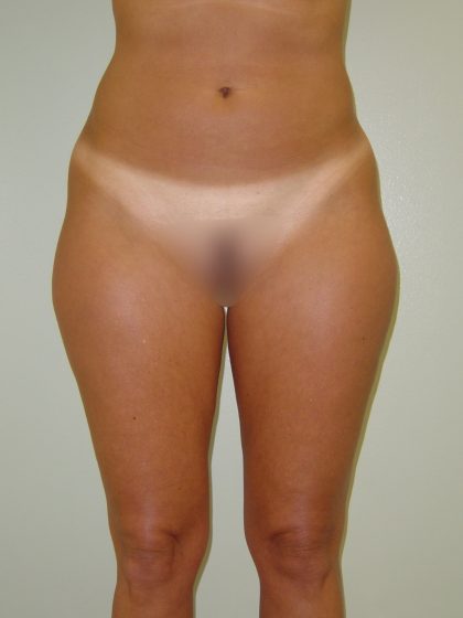 Liposuction Before & After Patient #1760