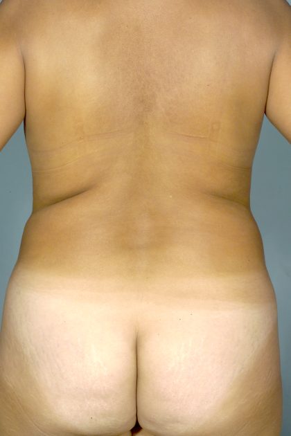 Liposuction Before & After Patient #1759