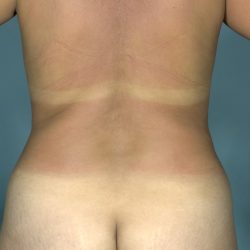 Liposuction Before & After Patient #1759