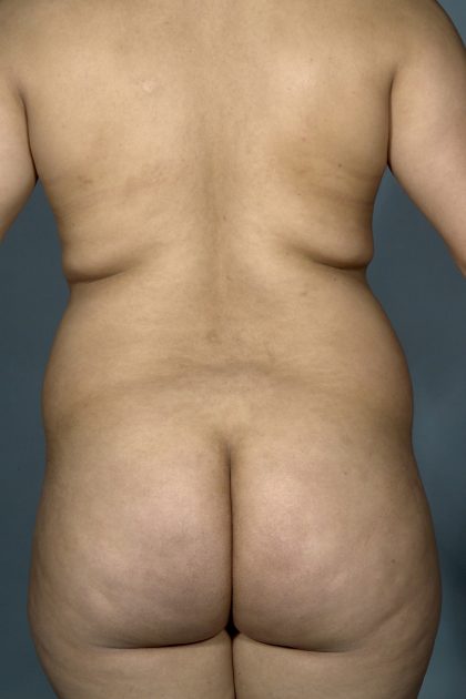 Liposuction Before & After Patient #1757