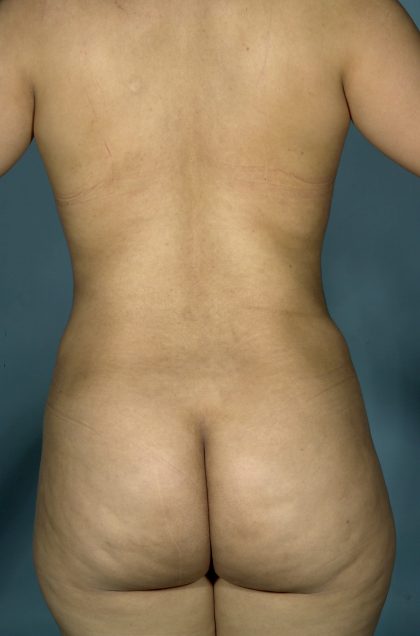 Liposuction Before & After Patient #1757