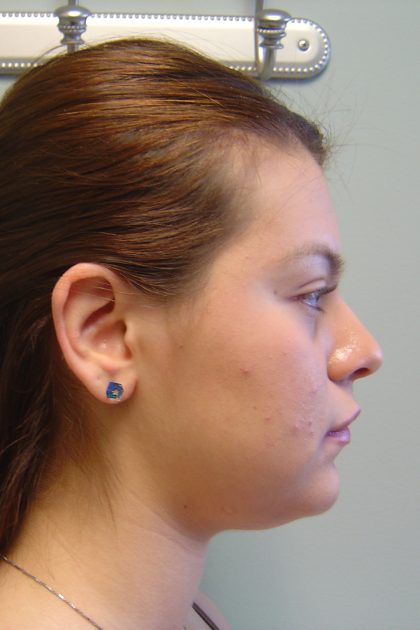 Neck liposuction Before & After Patient #1679