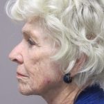 Necklift Before & After Patient #1680