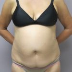 Tummy Tuck Before & After Patient #1775