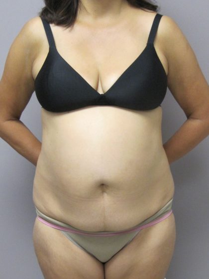 Tummy Tuck Before & After Patient #1775