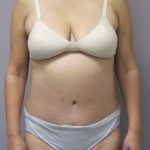 Tummy Tuck Before & After Patient #1775