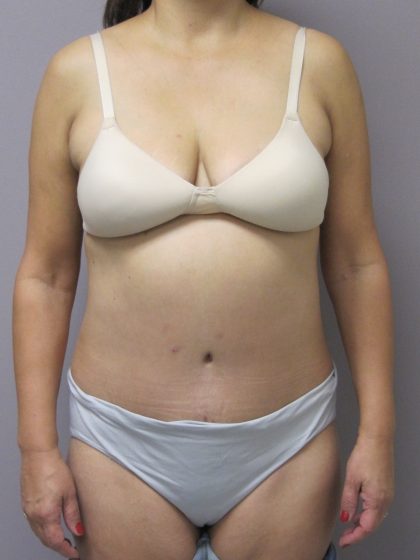 Tummy Tuck Before & After Patient #1775