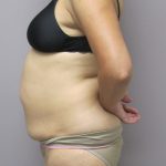 Tummy Tuck Before & After Patient #1775