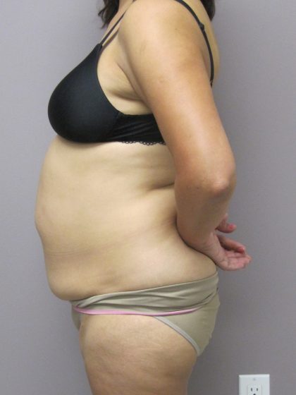 Tummy Tuck Before & After Patient #1775