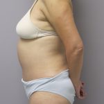 Tummy Tuck Before & After Patient #1775