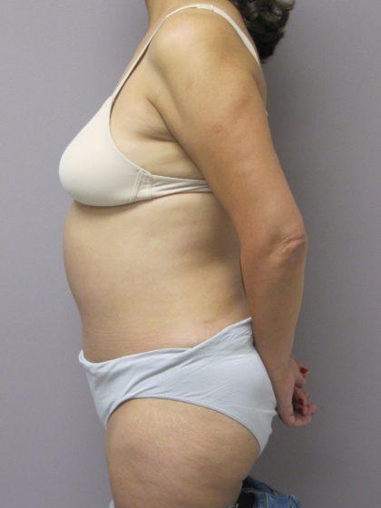 Tummy Tuck Before & After Patient #1775