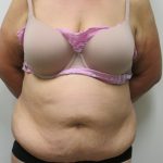 Tummy Tuck Before & After Patient #1774