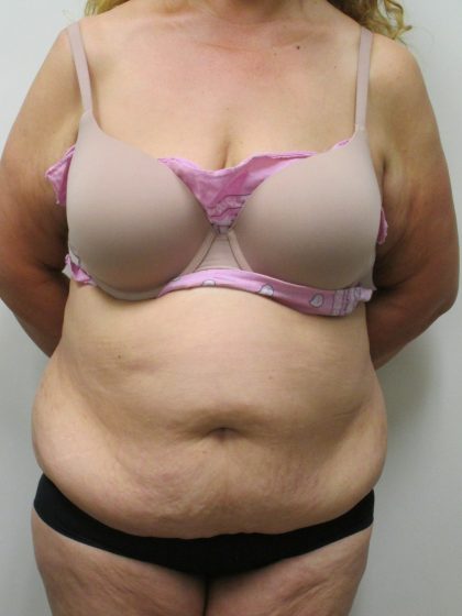 Tummy Tuck Before & After Patient #1774