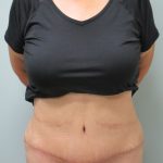 Tummy Tuck Before & After Patient #1774