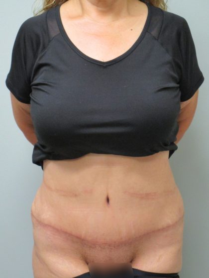 Tummy Tuck Before & After Patient #1774