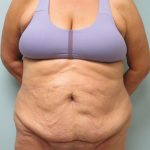 Tummy Tuck Before & After Patient #1772