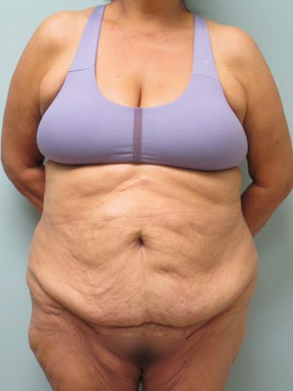 Tummy Tuck Before & After Patient #1772