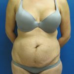 Tummy Tuck Before & After Patient #1771