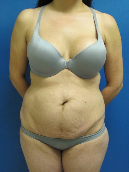 Tummy Tuck Before & After Patient #1771