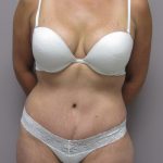 Tummy Tuck Before & After Patient #1771