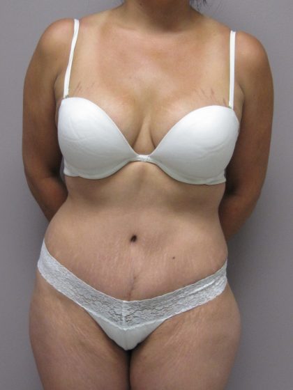 Tummy Tuck Before & After Patient #1771