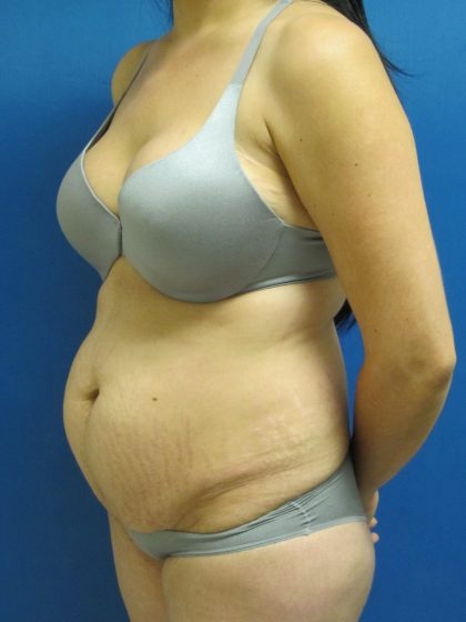 Tummy Tuck Before & After Patient #1771