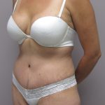 Tummy Tuck Before & After Patient #1771