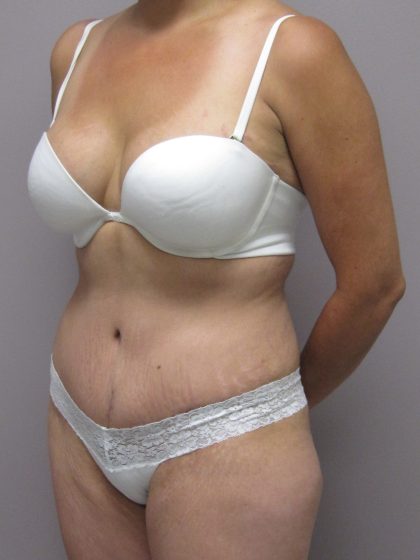 Tummy Tuck Before & After Patient #1771