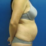 Tummy Tuck Before & After Patient #1771