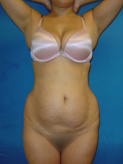 Tummy Tuck Before & After Patient #1770