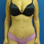 Tummy Tuck Before & After Patient #1770