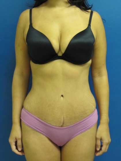 Tummy Tuck Before & After Patient #1770