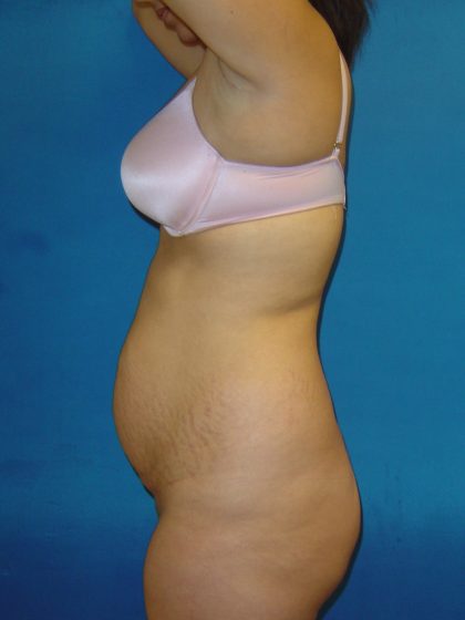 Tummy Tuck Before & After Patient #1770